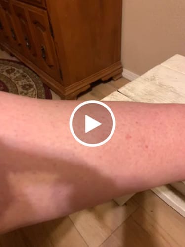 Customer photo review of Duftstofffreie, nicht fettende Anti-Juckreiz-Lotion mit Ceramid NP für trockene, gerötete und empfindliche Haut