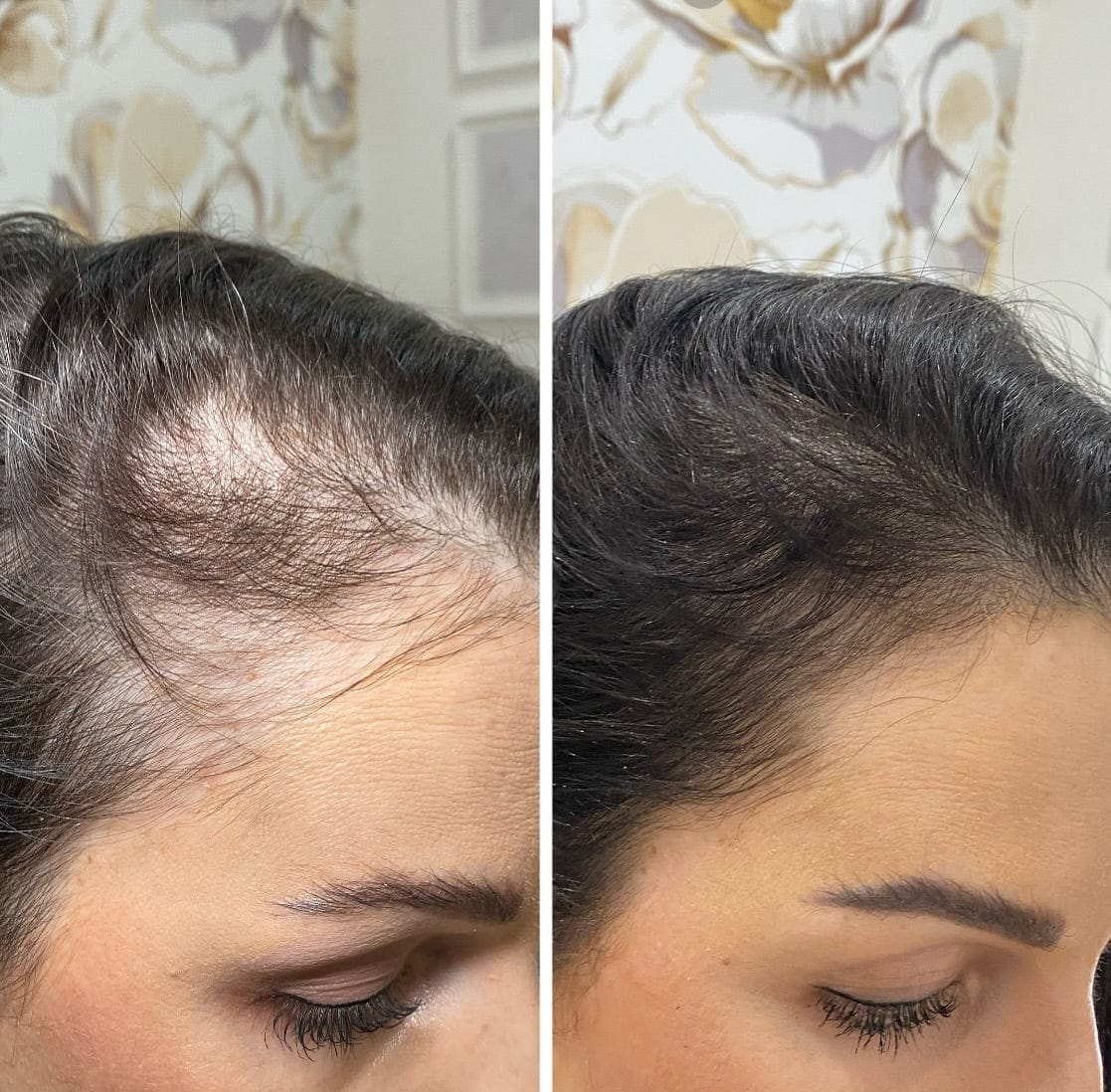 Customer photo review of Nolya Red Light Therapy Hair Brush