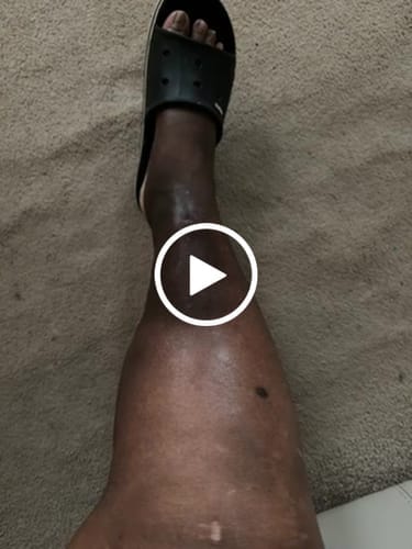 Customer photo review of Duftstofffreie, nicht fettende Anti-Juckreiz-Lotion mit Ceramid NP für trockene, gerötete und empfindliche Haut