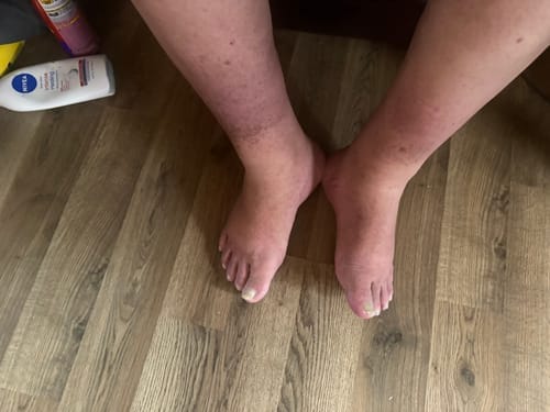 Customer photo review of Duftstofffreie, nicht fettende Anti-Juckreiz-Lotion mit Ceramid NP für trockene, gerötete und empfindliche Haut