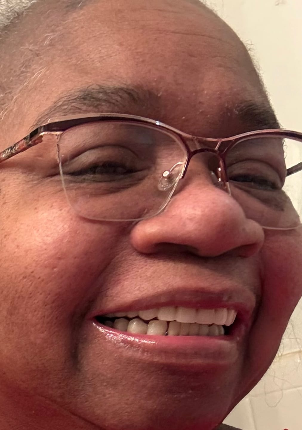 Customer photo review of Clear Flexible Partial Denture