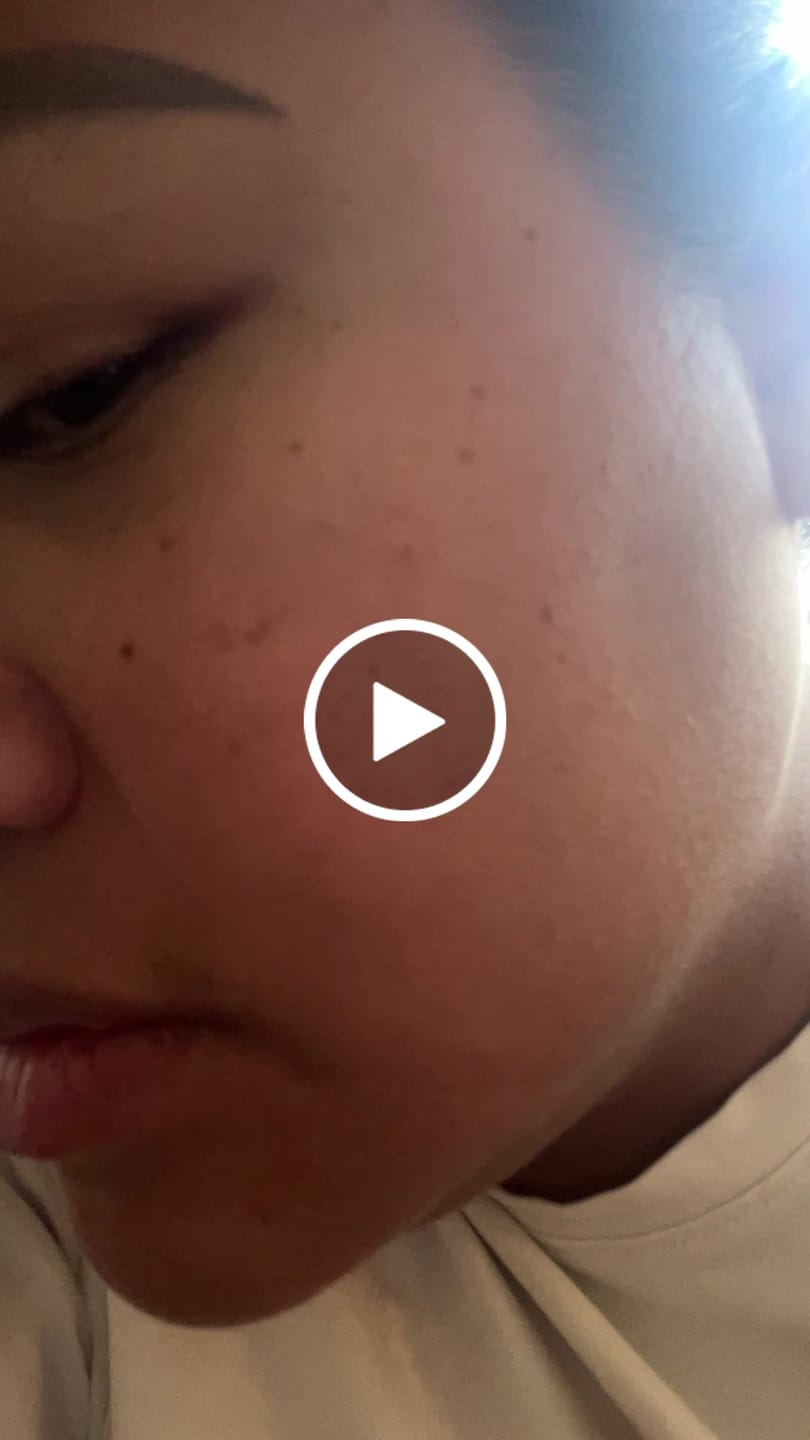 Customer video review of Medisco Skinbooster PDRN EXO - Exosome & PDRN Skin Reviving Formula