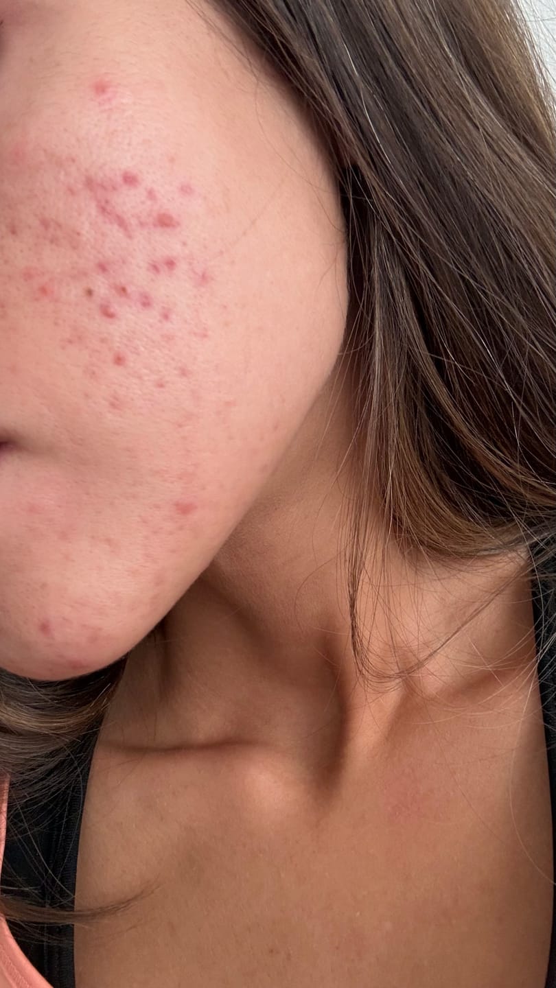 Customer photo review of MIRACLE H -  ÁCIDO HIPOCLOROSO - TÓNICO ANTIBACTERIANO Y ANTIINFLAMATORIO
