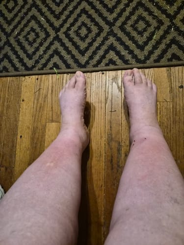 Customer photo review of Duftstofffreie, nicht fettende Anti-Juckreiz-Lotion mit Ceramid NP für trockene, gerötete und empfindliche Haut