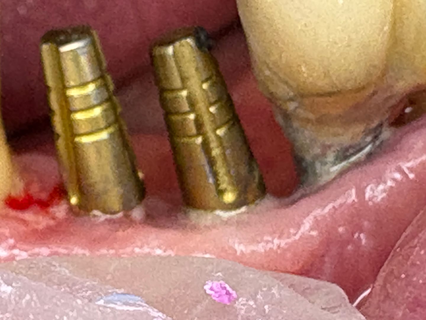 Customer photo review of ALTO® One-Piece Dental Implant Ø4.0 immediate load - Monoblock System