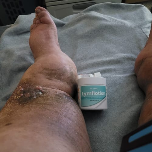 Customer photo review of Duftstofffreie, nicht fettende Anti-Juckreiz-Lotion mit Ceramid NP für trockene, gerötete und empfindliche Haut