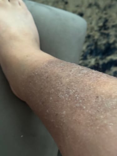 Customer photo review of Duftstofffreie, nicht fettende Anti-Juckreiz-Lotion mit Ceramid NP für trockene, gerötete und empfindliche Haut