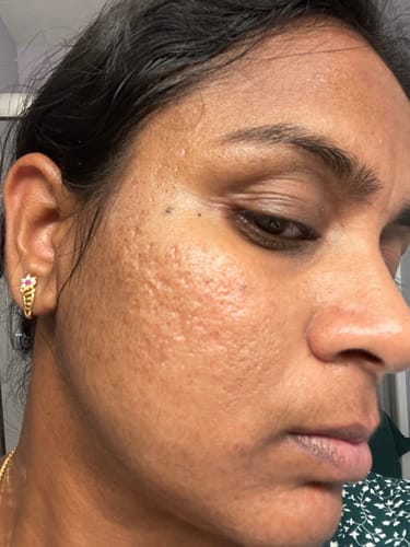 Customer photo review of No More Pore Pads