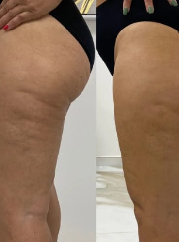 Customer photo review of Candela Anti - Estrias Crema Reductora