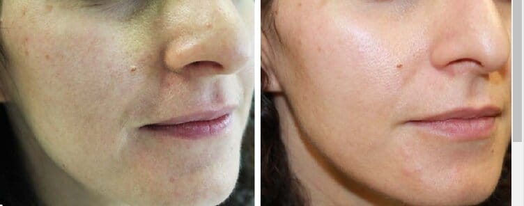 Customer photo review of Lumyhealth Salon LED Light Therapy Device