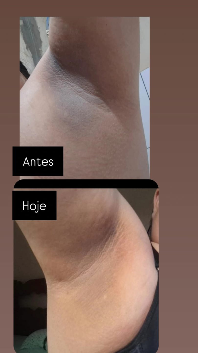 Customer photo review of Creme Clareador de Manchas – Melasma, Axilas, Virilha, Áreas Íntimas, Rosto e Corpo