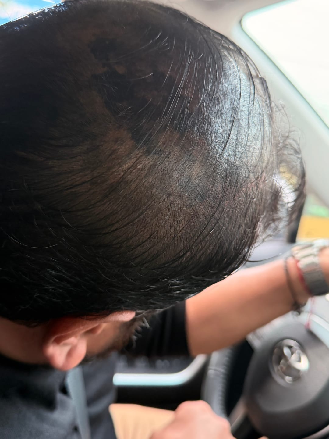Customer photo review of SKALPURE – Crema Corrector Capilar 50ml | Cubre Calvicie y Entradas