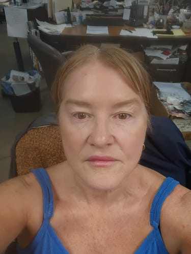 Customer's face showing results after three months of using the Seranova Micro Infusion System.