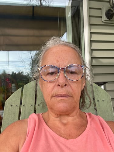 Customer's face after using Seranova Micro Infusion System treatments, shown while relaxing in an outdoor chair.