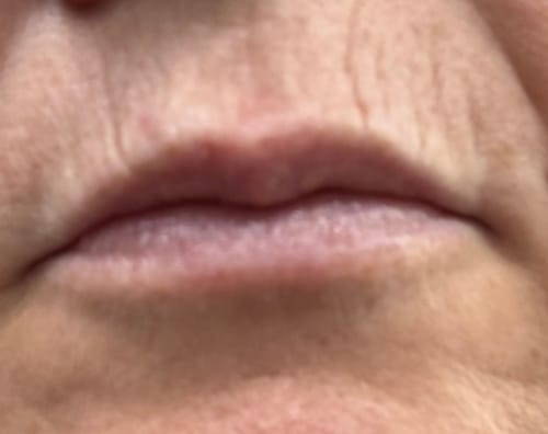 Reviewer's close-up view of the skin around their lips, showing fine lines being treated with The Micro Infusion System.