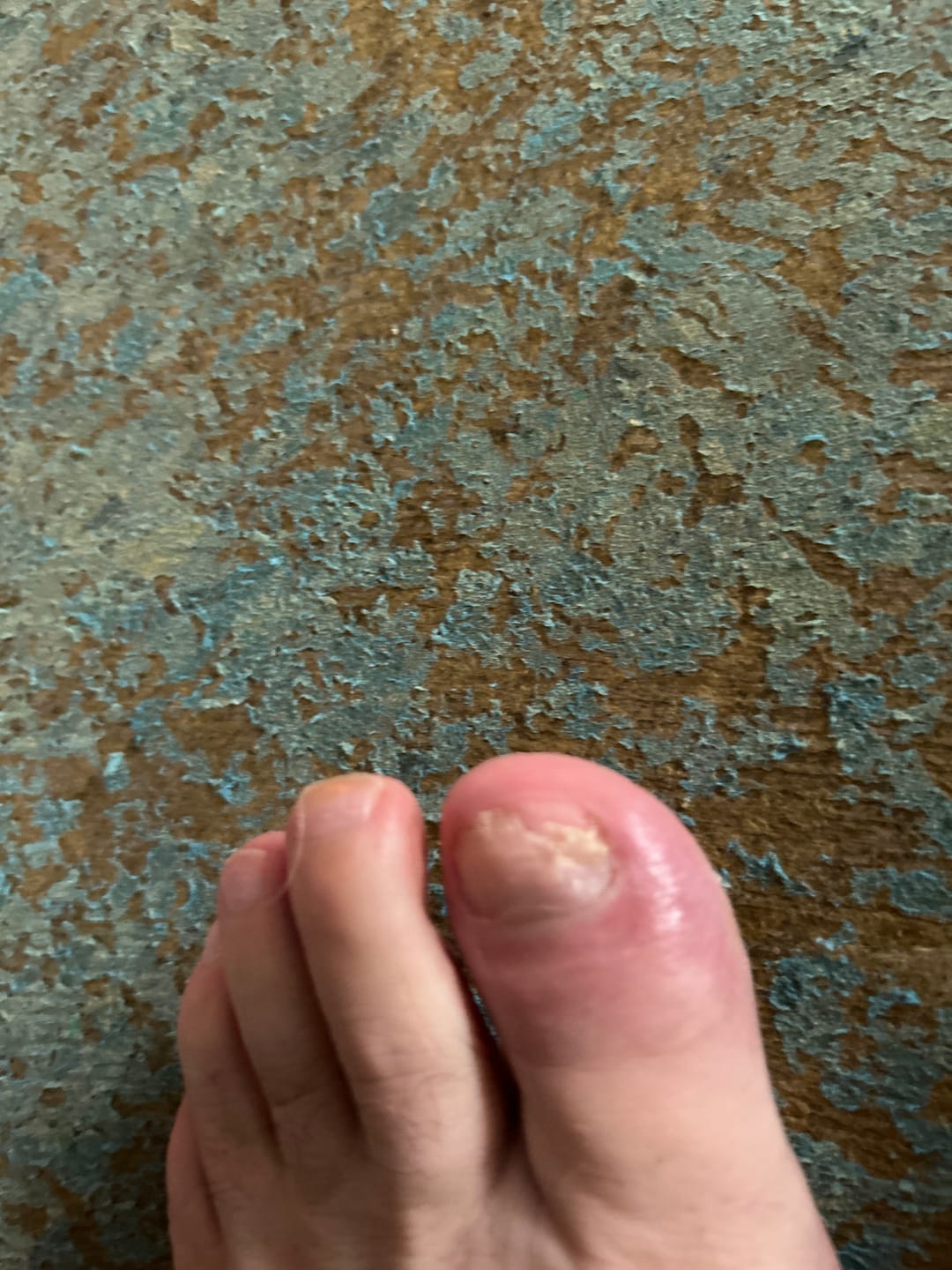 Customer photo review of VELCURA™ Fungal Nail Patches