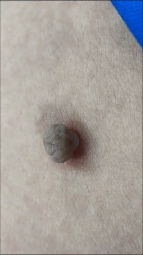 Customer photo review of Removedor Indoloro de Fibromas