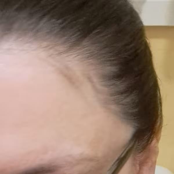 Customer photo review of Nuvrela™ Hair Growth Formula (Pumpkin Seed Oil + Saw Palmetto)