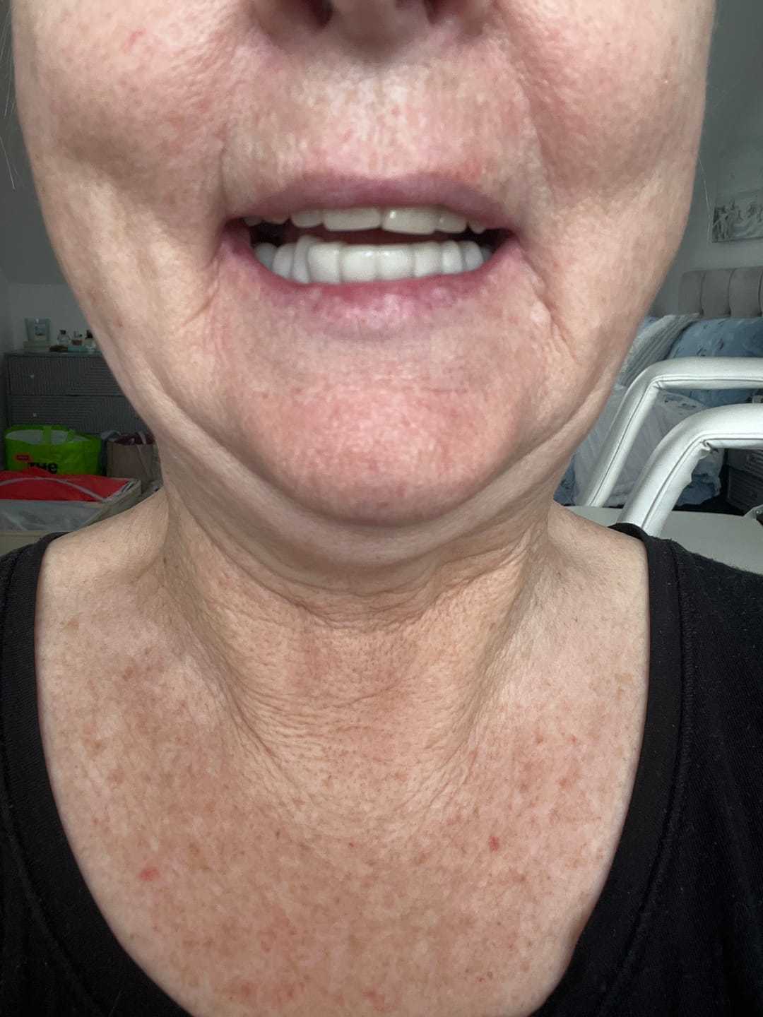 Customer photo review of Click-in Veneers 4.0