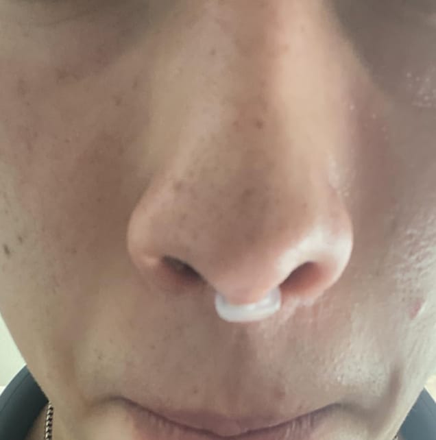 Customer photo review of FLO Nasal Dilator (3 Pack)