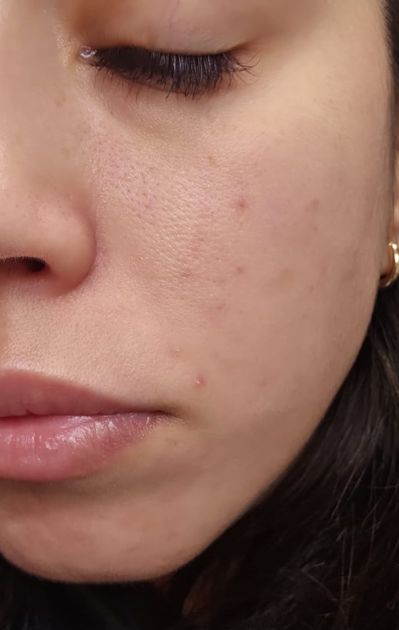 Customer photo review of A CONTROL - ACNÉ HORMONAL & RESISTENCIA A LA INSULINA