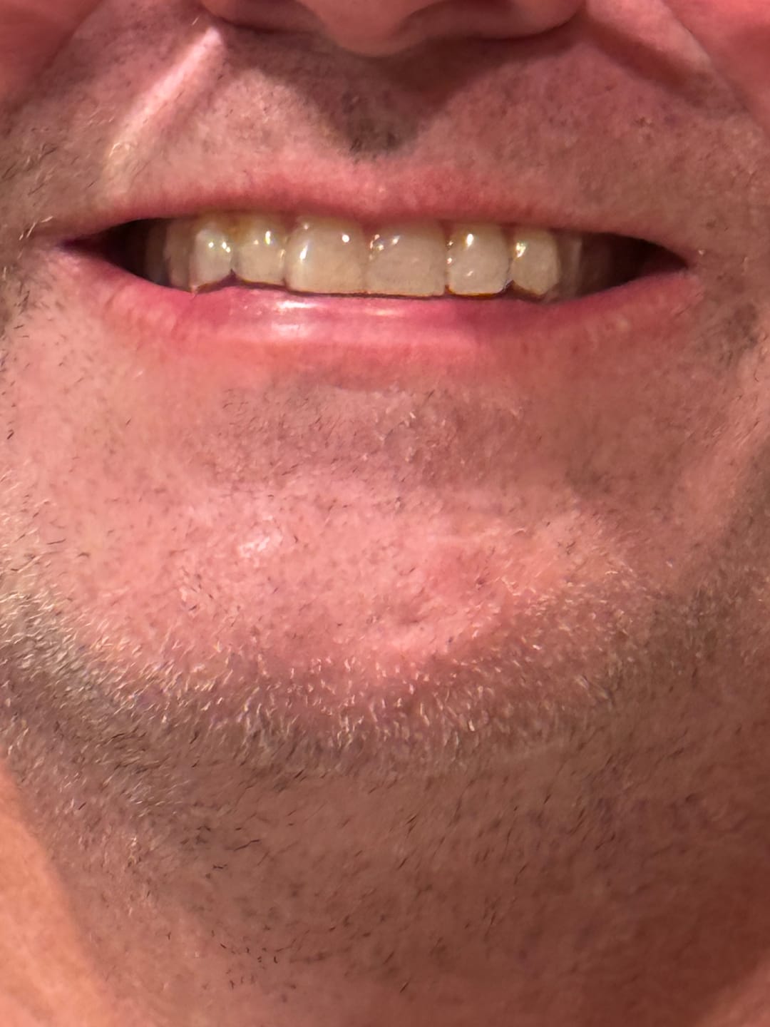 Customer photo review of Clear Custom Night Guard