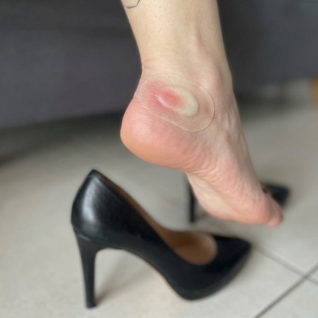 Customer photo review of Dermozzis Apósito Corrector Hidrocoloide.
