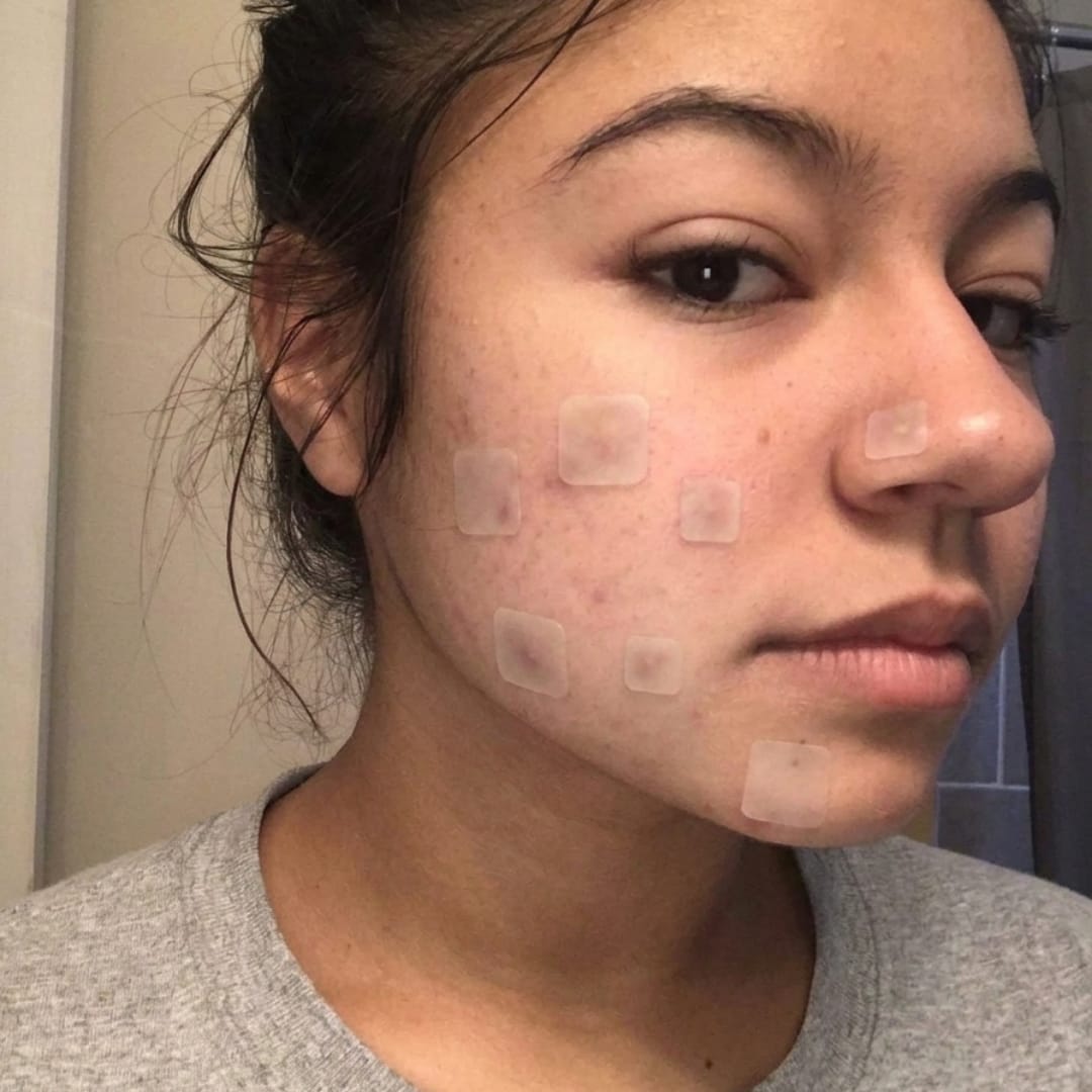 Customer photo review of Dermozzis Apósito Corrector Hidrocoloide.