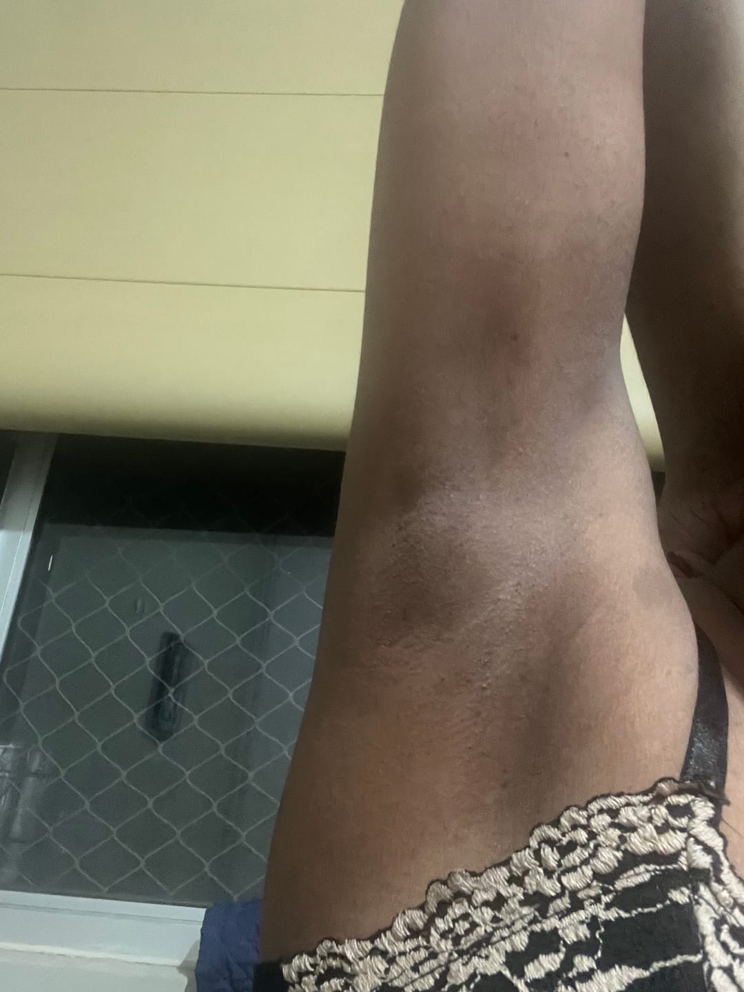 Customer photo review of Creme Clareador de Manchas – Melasma, Axilas, Virilha, Áreas Íntimas, Rosto e Corpo