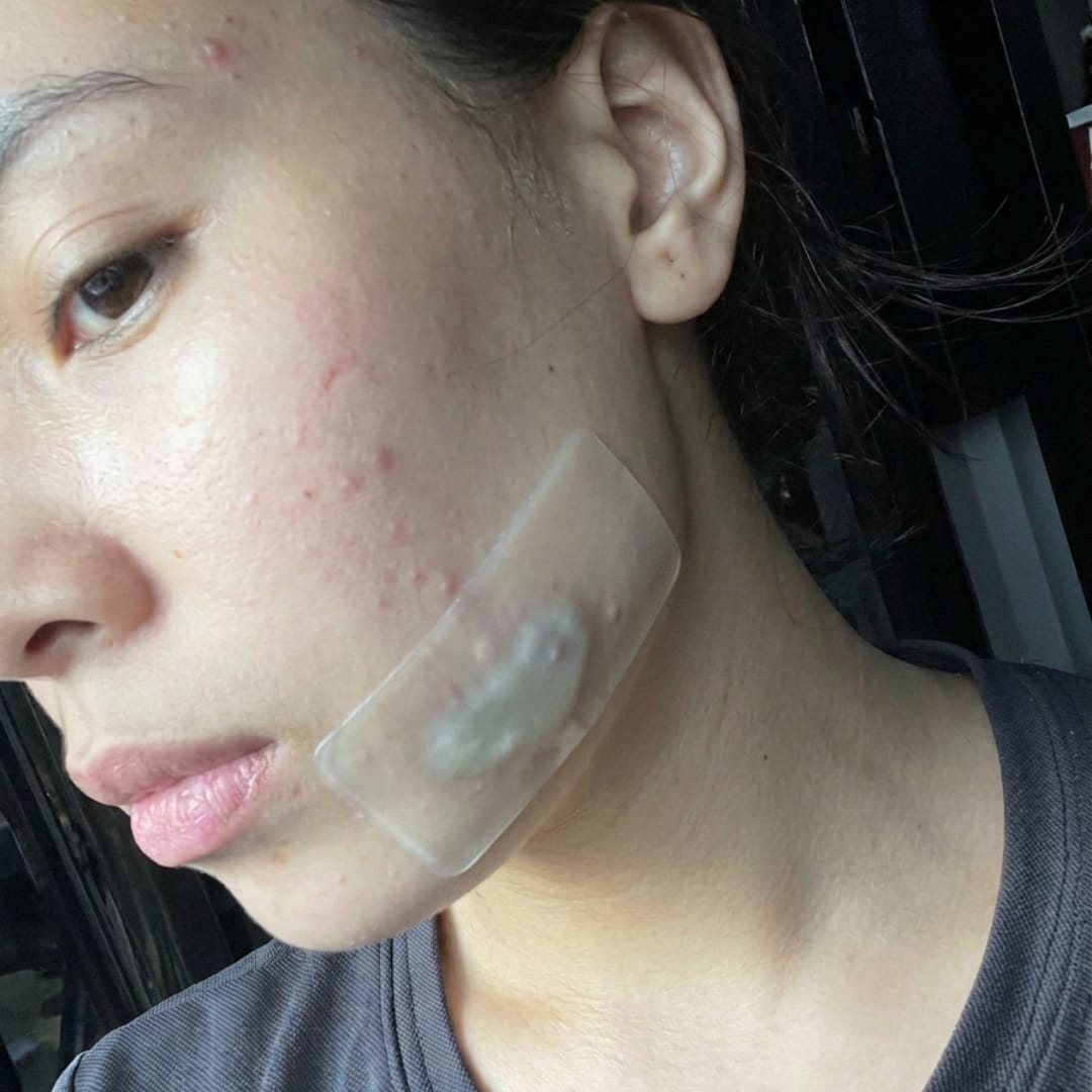 Customer photo review of Dermozzis Apósito Corrector Hidrocoloide.