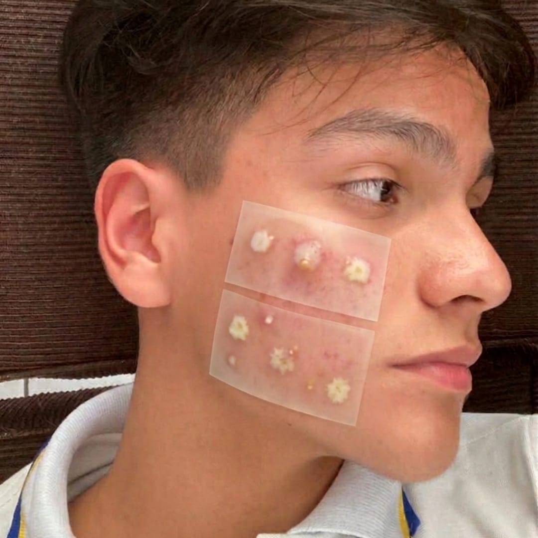 Customer photo review of Dermozzis Apósito Corrector Hidrocoloide.