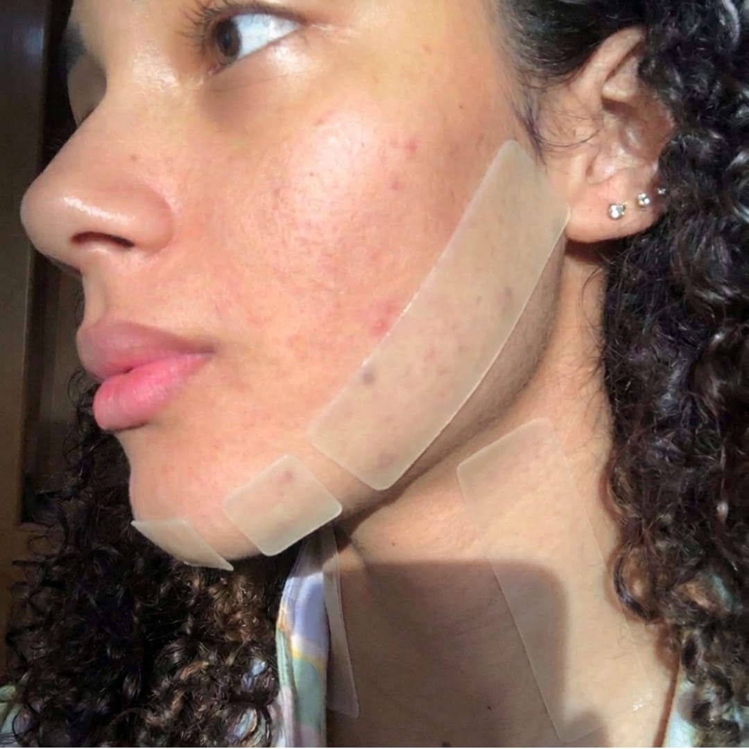 Customer photo review of Dermozzis Apósito Corrector Hidrocoloide.