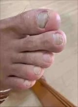 Customer photo review of NOREVEX: El aceite que elimina el 99.9% de los hongos en tus uñas.