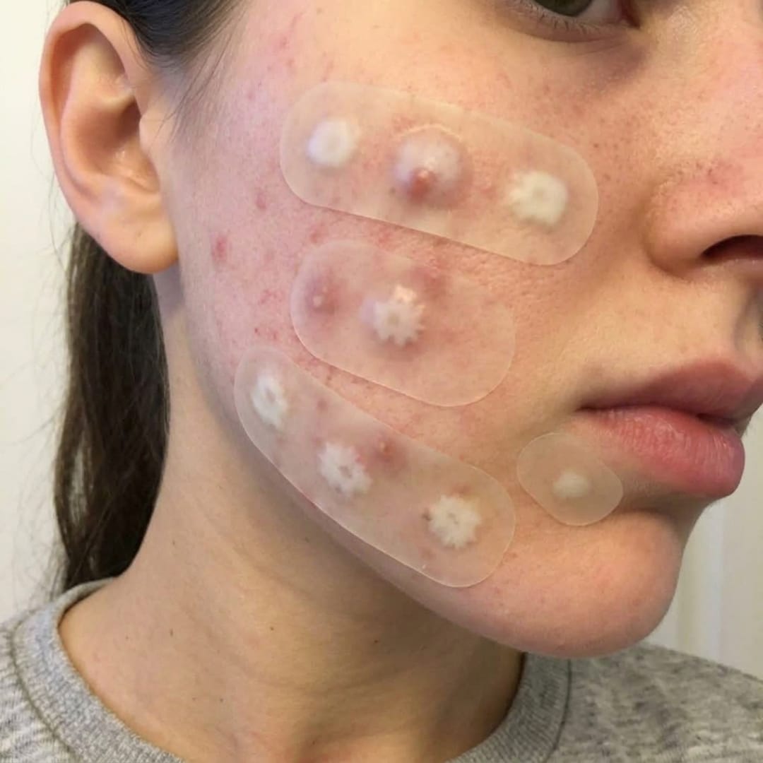 Customer photo review of Dermozzis Apósito Corrector Hidrocoloide.