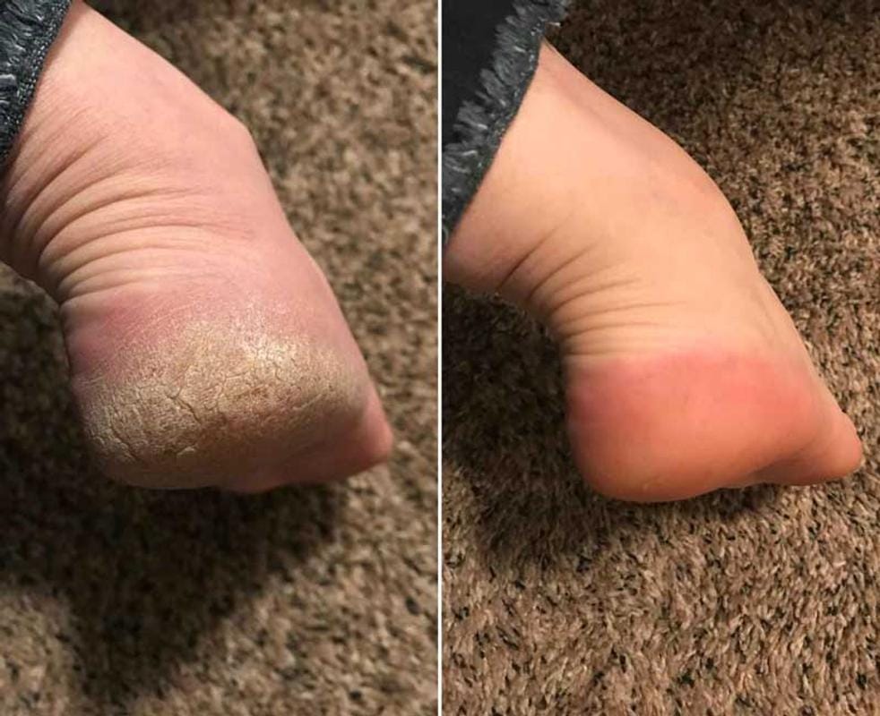 Customer photo review of Pulidor Eléctrico de Talones