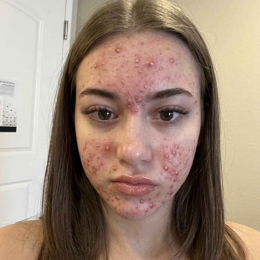 Customer photo review of Dermozzis Apósito Corrector Hidrocoloide.