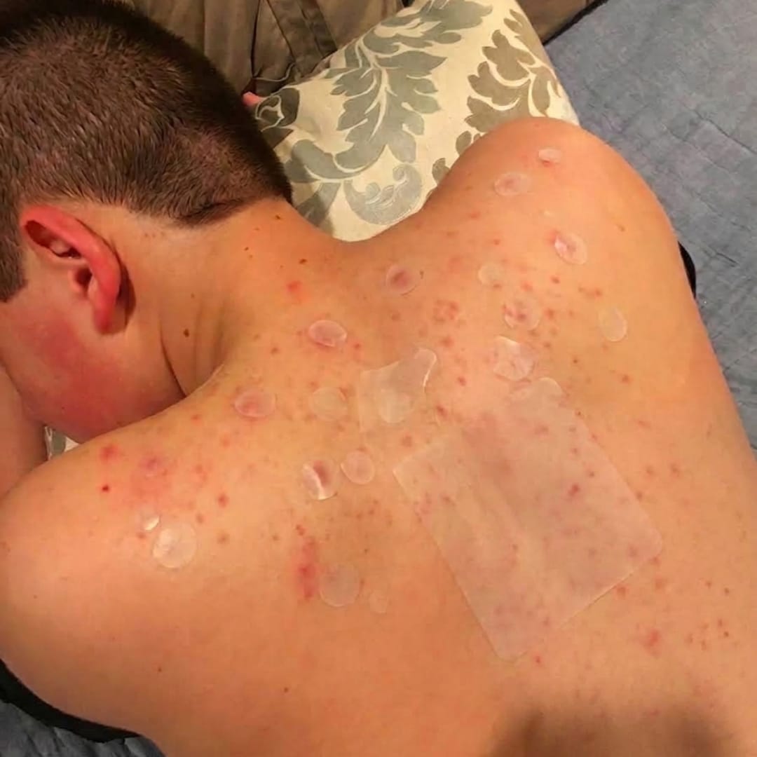 Customer photo review of Dermozzis Apósito Corrector Hidrocoloide.