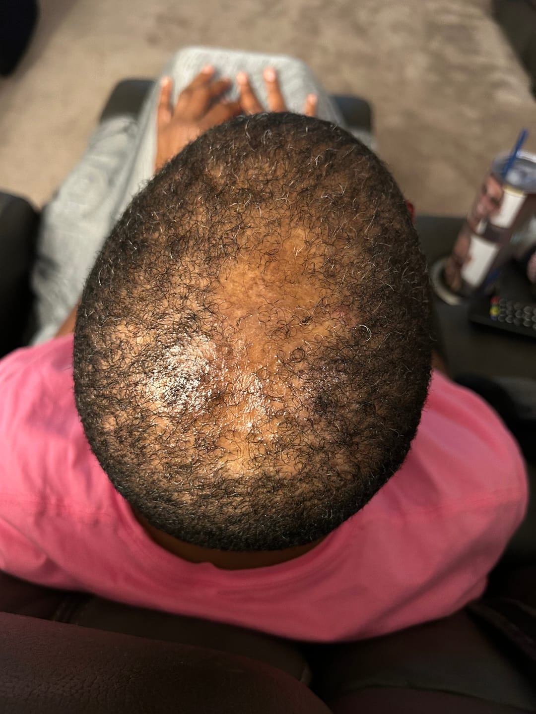Customer photo review of Scalp Therapy System