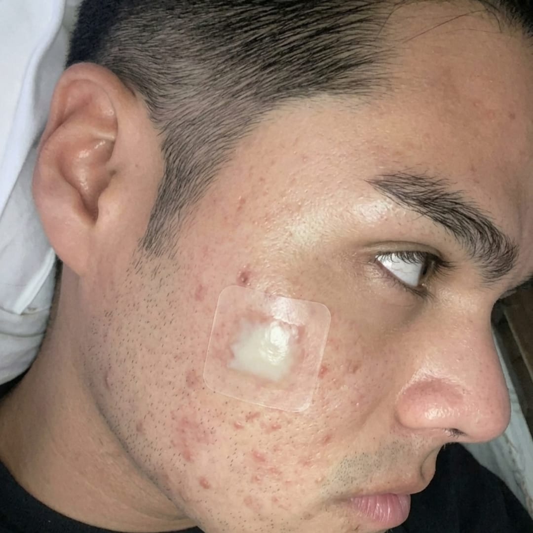 Customer photo review of Dermozzis Apósito Corrector Hidrocoloide.