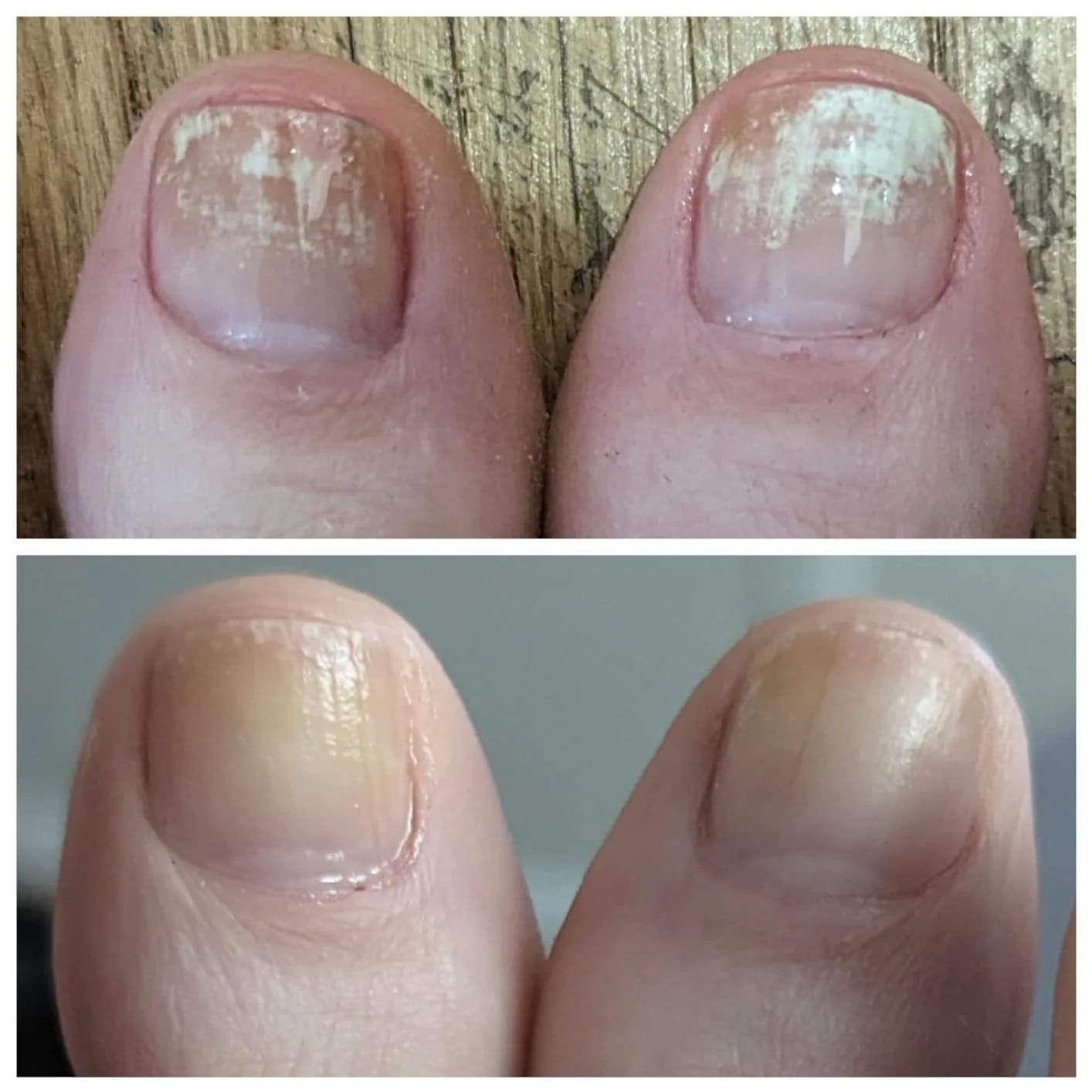 Customer photo review of NOREVEX: El aceite que elimina el 99.9% de los hongos en tus uñas.
