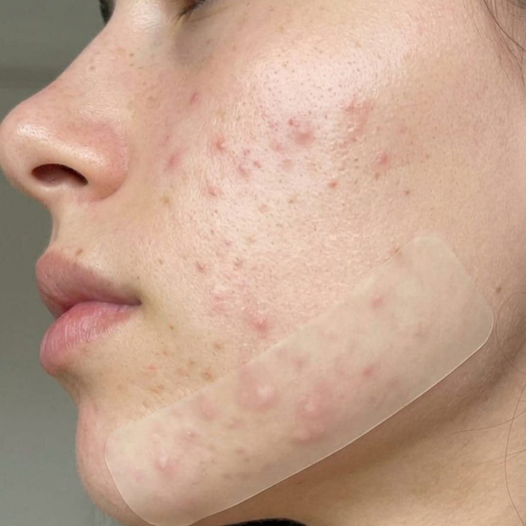 Customer photo review of Dermozzis Apósito Corrector Hidrocoloide.