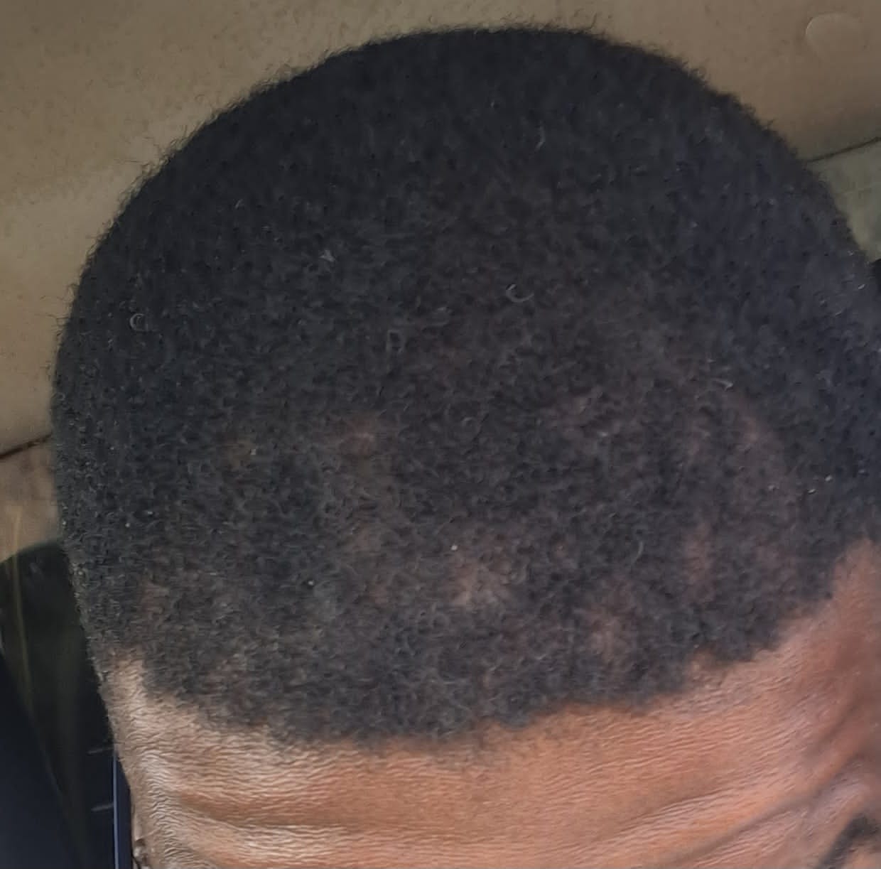 Customer photo review of Minoxidil 5% SOLUTION, 3 x 60ml pack