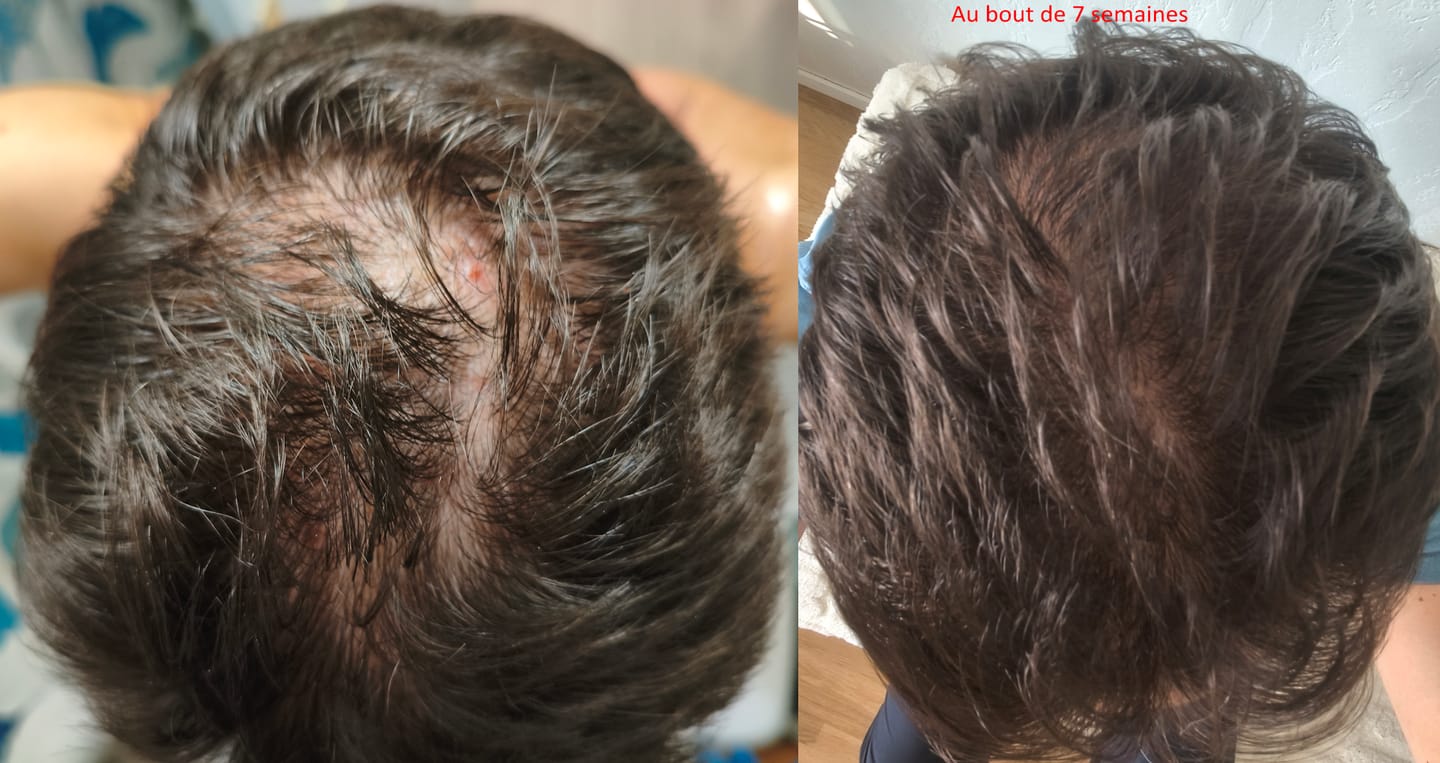 Customer photo review of Sérum au Redensyl Activateur de Pousse Cheveux