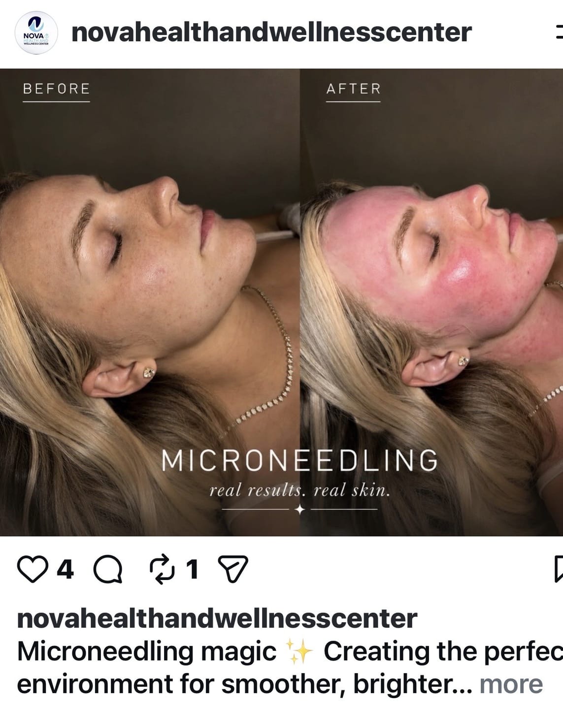 Customer photo review of Metamorph 8.5 Face & Body Contouring System 3 in 1