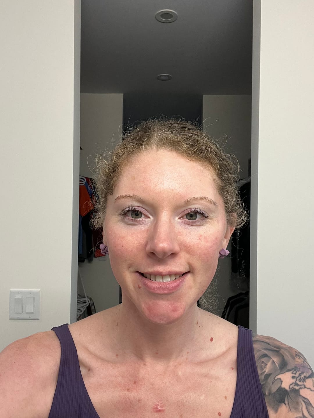 Customer photo review of The Complete System for Acne-Prone Skin