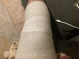 Customer photo review of Ginocchiera in Bambù Orthotal