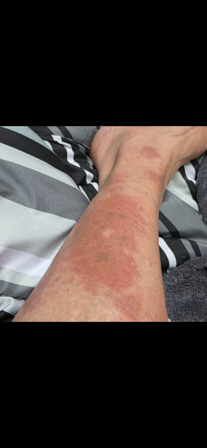 Customer photo review of Smiles & Joys Eczema and Psoriasis Herbal Cream