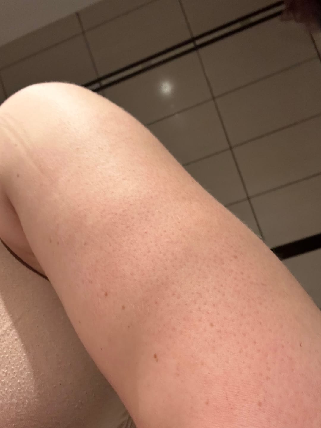 Customer photo review of Rūgštinis odos purškalas nuo spuogų