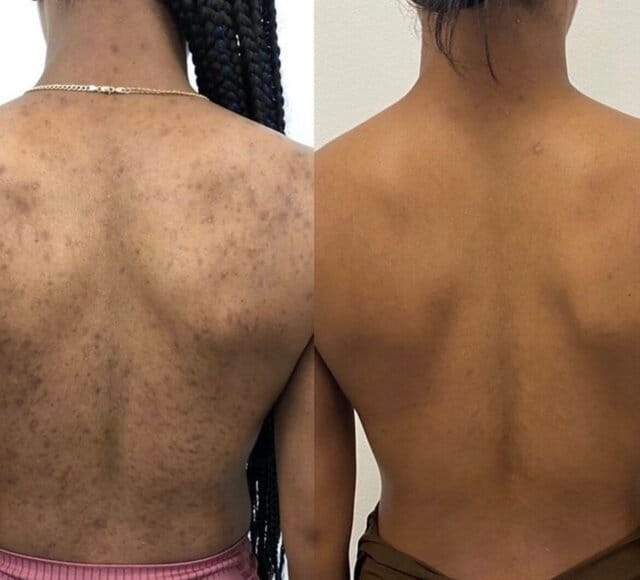 Customer photo review of Lucrown Body Acne Wash