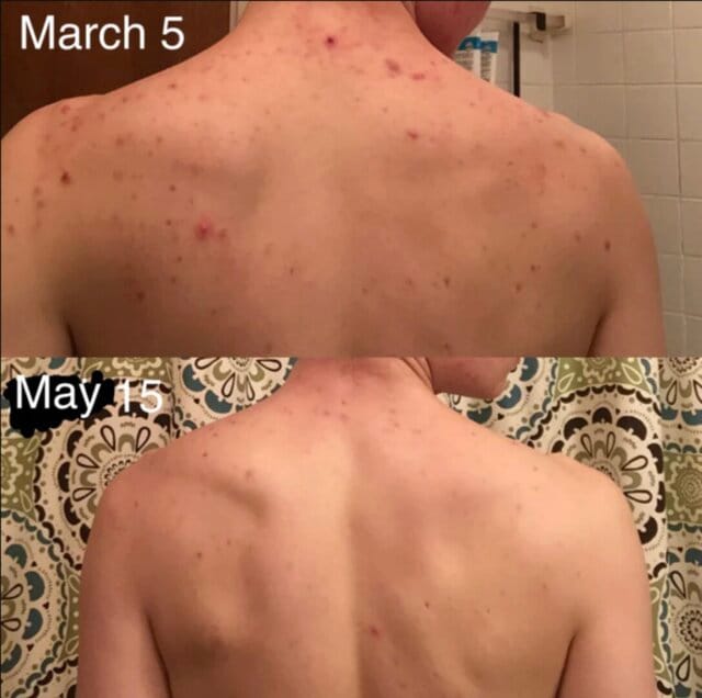 Customer photo review of Lucrown Body Acne Wash